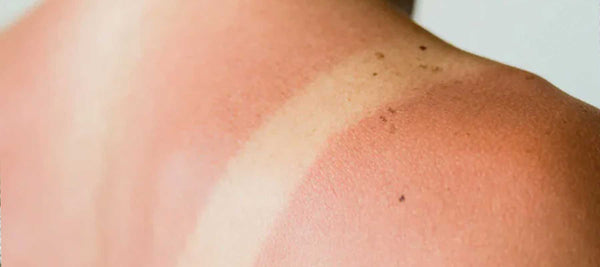 How to use Manuka Honey for burns